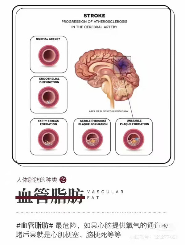 血管脂肪 最危险🆘