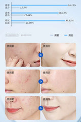 仁和匠心水杨酸祛痘净肤面膜Salicylic Acid Acne Purifying Mask 10 pieces/box