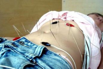 针灸减肥   acupuncture to lose weight