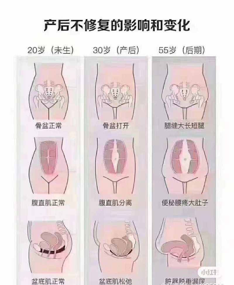 产后康复