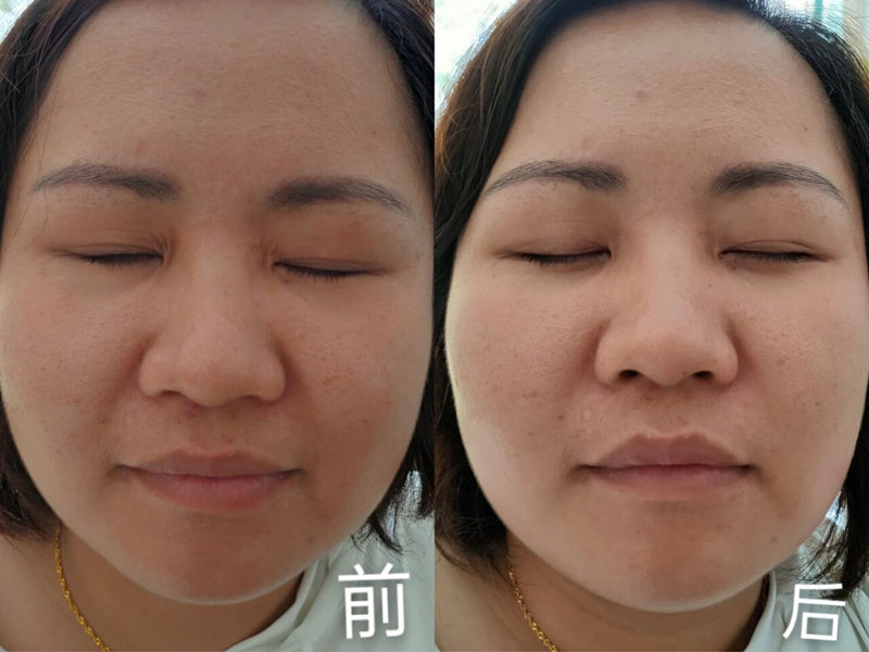 脸部及颈部除皱或瘦脸 face lift