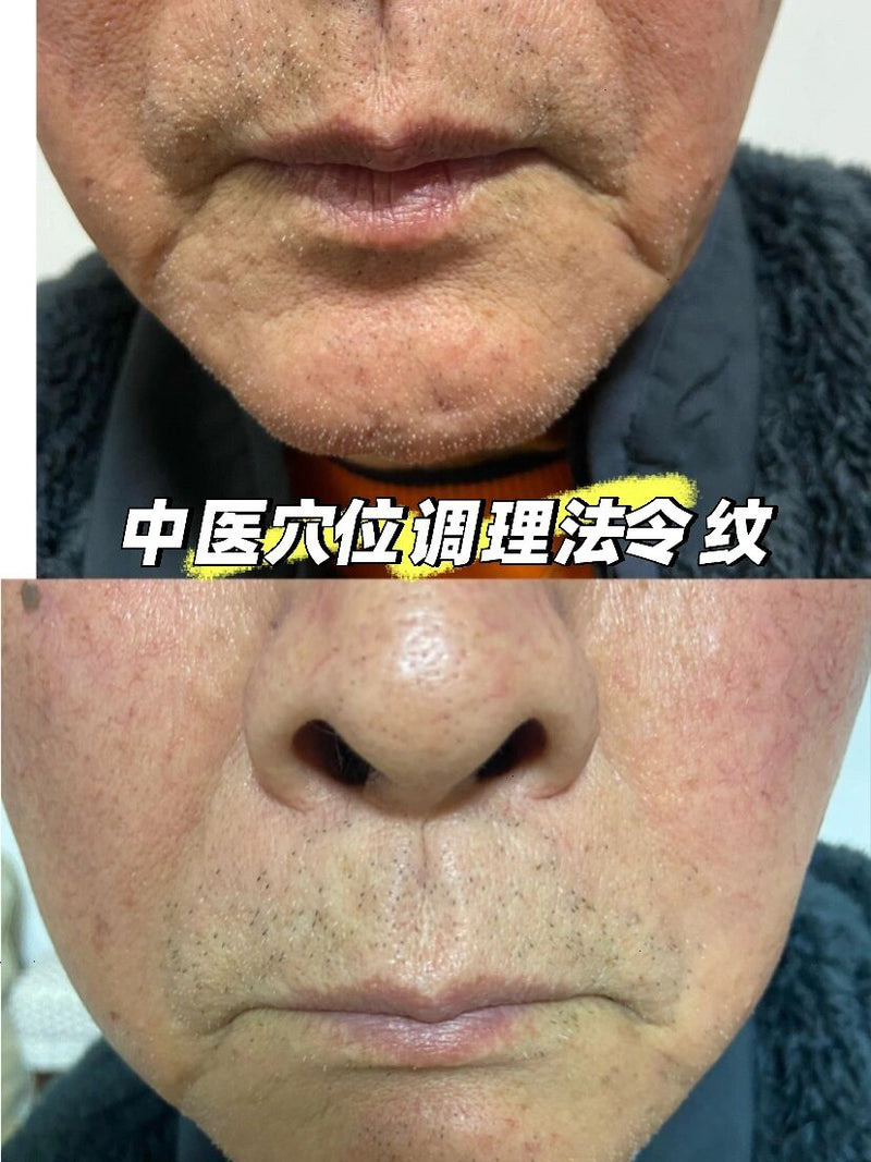 脸部及颈部除皱或瘦脸 face lift