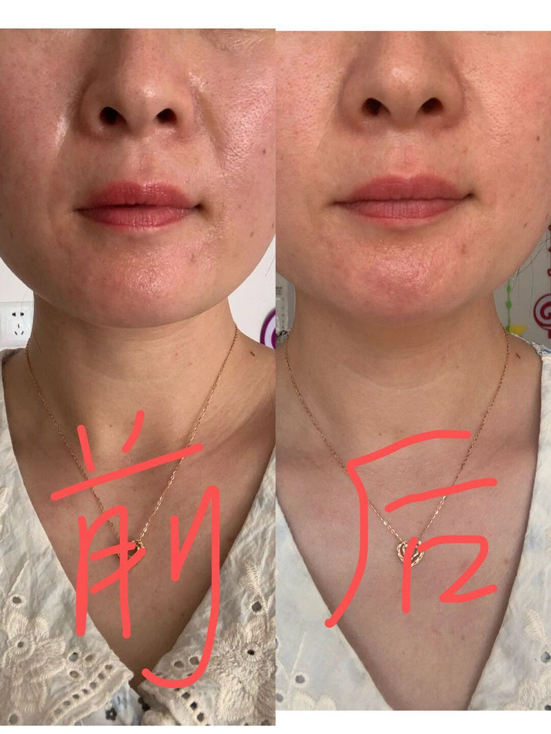 脸部及颈部除皱或瘦脸 face lift